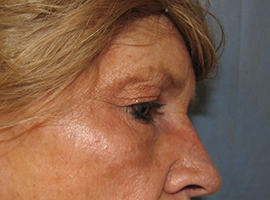 Blepharoplasty