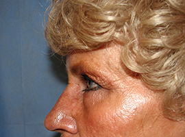 Blepharoplasty