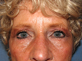 Blepharoplasty