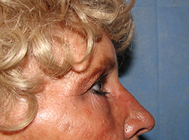 Blepharoplasty