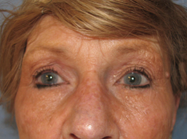 Blepharoplasty