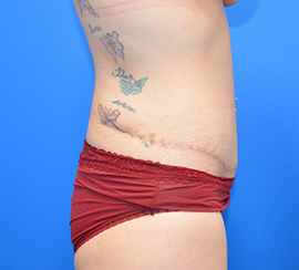 Tummy Tuck