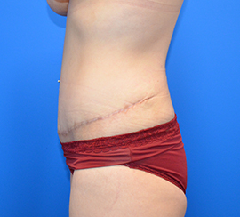 Tummy Tuck