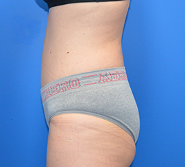 Tummy Tuck