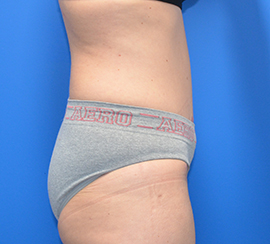 Tummy Tuck