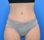 Tummy Tuck