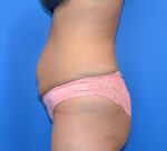 Tummy Tuck