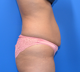 Tummy Tuck