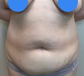 Tummy Tuck