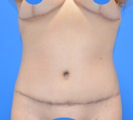 Tummy Tuck