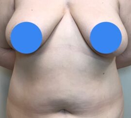 Breast Lift