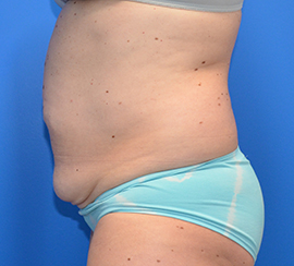 Tummy Tuck