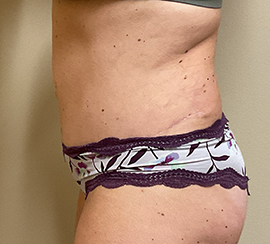 Tummy Tuck