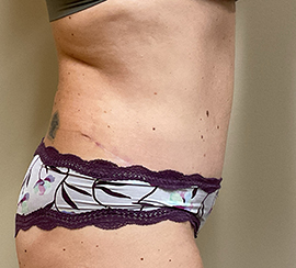 Tummy Tuck