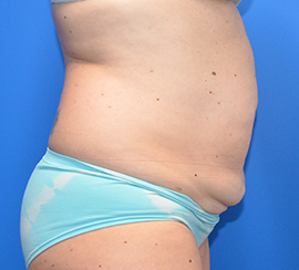 Tummy Tuck