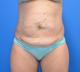 Tummy Tuck