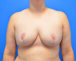 Breast Reduction