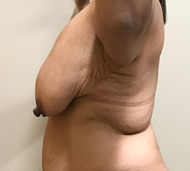 Breast Lift