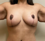 Breast Reduction/Breast Lift