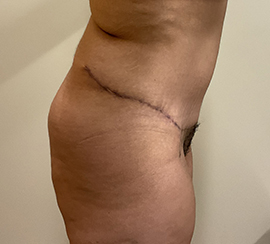 Tummy Tuck