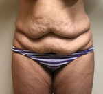 Tummy Tuck