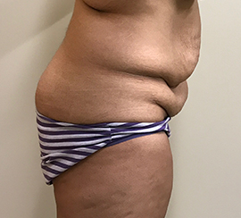 Tummy Tuck