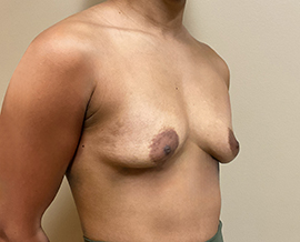 Breast Augmentation